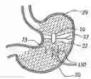 Fig. 01 - Device, system and method for in-vivo imaging of a body lumen