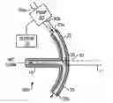 Fig. 01 - Intraocular shunt device and method
