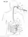 Fig. 04 - Gastrointestinal applicator and method of using same