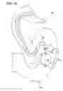 Fig. 13 - Gastrointestinal applicator and method of using same
