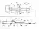 Fig. 01 - Peg tube with wireless pull tip
