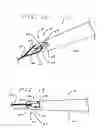Fig. 11 - Peg tube with wireless pull tip