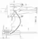 Fig. 03 - Method and apparatus for peritoneal hypothermia and/or resuscitation