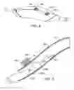 Fig. 06 - Methods and kits for delivering pharmaceutical agents into the coronary vascular adventitia