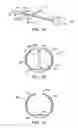 Fig. 03 - Methods and kits for delivering pharmaceutical agents into the coronary vascular adventitia