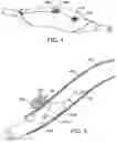 Fig. 06 - Methods and kits for delivering pharmaceutical agents into the coronary vascular adventitia