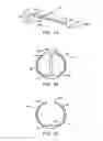 Fig. 03 - Methods and kits for delivering pharmaceutical agents into the coronary vascular adventitia