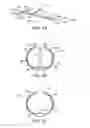 Fig. 03 - Methods and kits for delivering pharmaceutical agents into the coronary vascular adventitia