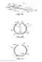 Fig. 03 - Methods and kits for delivering pharmaceutical agents into the coronary vascular adventitia