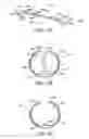 Fig. 03 - Methods and kits for delivering pharmaceutical agents into the coronary vascular adventitia