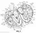 Fig. 03 - Retrograde pressure regulated infusion
