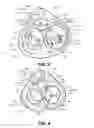 Fig. 04 - Retrograde pressure regulated infusion