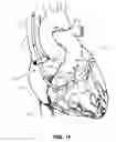 Fig. 09 - Retrograde pressure regulated infusion