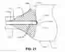 Fig. 17 - Retrograde pressure regulated infusion