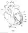 Fig. 05 - Methods for directly injecting plug forming materials from a catheter