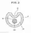Fig. 03 - Catheter