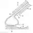Fig. 01 - Conformable electrode catheter and method of use