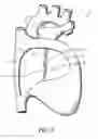 Fig. 03 - Conformable electrode catheter and method of use