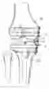 Fig. 01 - Internal brace for distraction arthroplasty