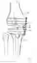 Fig. 03 - Internal brace for distraction arthroplasty