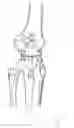 Fig. 04 - Internal brace for distraction arthroplasty