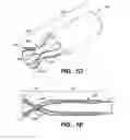Fig. 03 - Anastomosis apparatus and methods