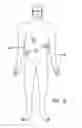 Fig. 03 - Trocars with advanced fixation