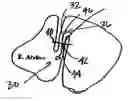 Fig. 01 - Tissue opening occluder