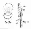 Fig. 06 - Tissue opening occluder