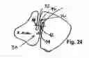 Fig. 07 - Tissue opening occluder