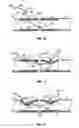 Fig. 05 - Sickle needle and method