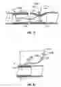 Fig. 06 - Sickle needle and method