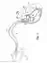 Fig. 02 - Pacing device for minimizing ventricular pauses after delivery of atrial anti-tachycardia pacing therapy