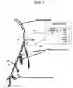 Fig. 04 - Electrical stimulation treatment of bronchial constriction