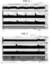 Fig. 06 - Electrical stimulation treatment of bronchial constriction