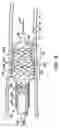Fig. 06 - Stent deployment systems and methods