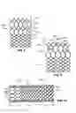 Fig. 06 - Multi-section filamentary endoluminal stent