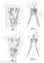 Fig. 02 - Implantable medical device with constrained expansion
