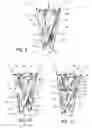 Fig. 04 - Implantable medical device with constrained expansion
