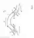 Fig. 03 - Method and apparatus for enhanced corneal accommodation