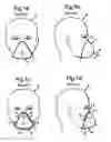Fig. 02 - Oro-nasal mask