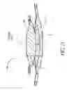 Fig. 14 - Single-piece accommodating intraocular lens system