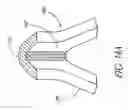 Fig. 40 - Single-piece accommodating intraocular lens system