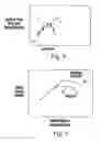 Fig. 05 - Method for determining objective refraction using wavefront sensing