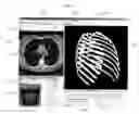 Fig. 03 - System and method for enhanced viewing of rib metastasis