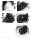 Fig. 09 - Methods for increasing capillary density and maintaining viability of microvascular cardiac endothelial cells using trk receptor ligands