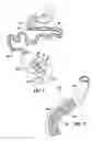 Fig. 02 - Disintegrating digestive tract barrier