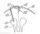 Fig. 01 - Method for shunting toxic substances from a brain ventricle to the sinus system