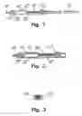 Fig. 02 - Method for shunting toxic substances from a brain ventricle to the sinus system