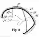 Fig. 05 - Method for shunting toxic substances from a brain ventricle to the sinus system